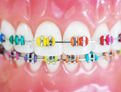 Braces: Types & How They Work