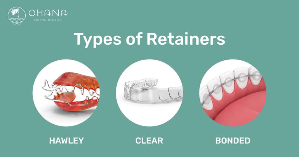 Types of Braces in Salem & Keizer OR - McDonald Orthodontics