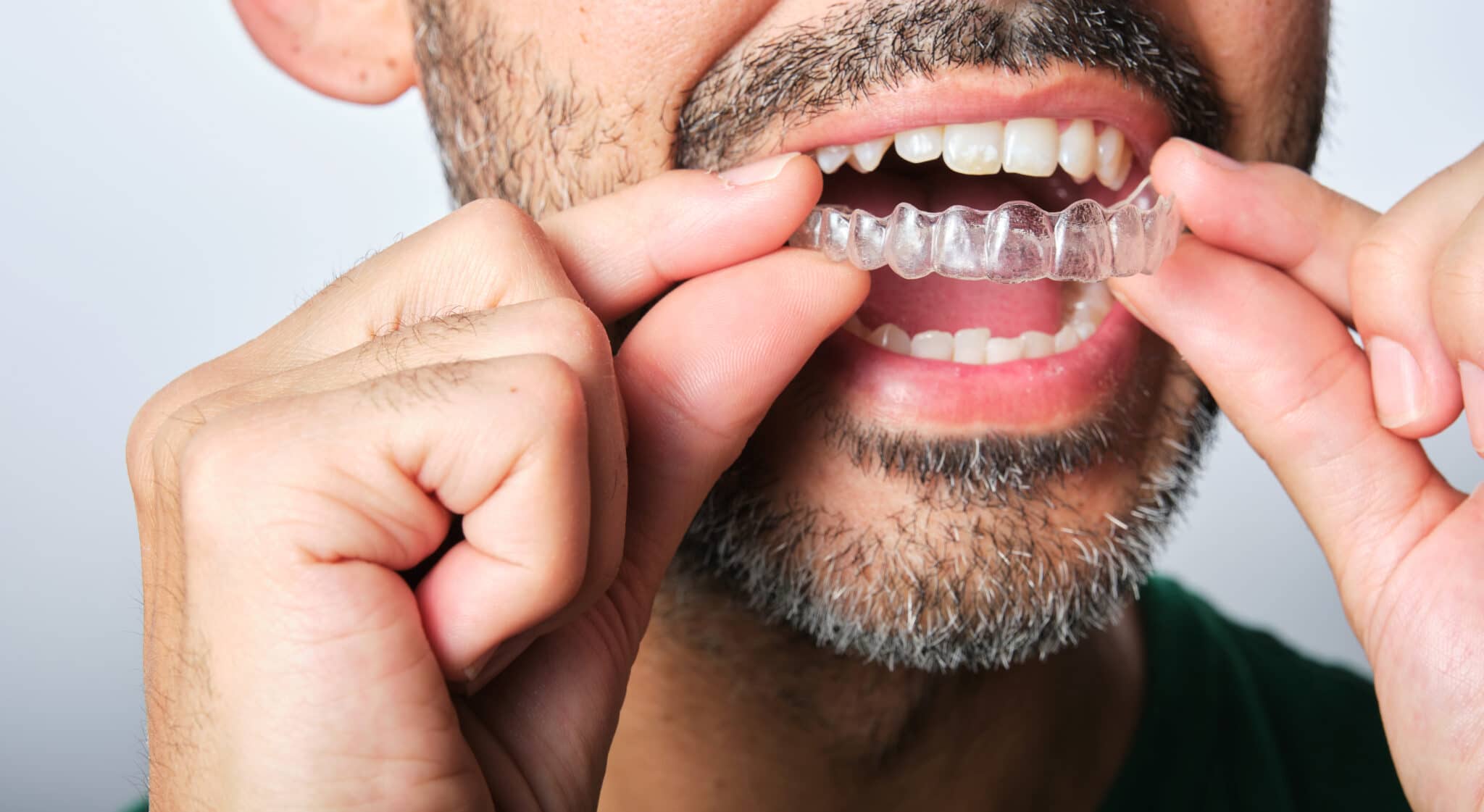 Everything You Need To Know About Attachments With Clear Aligners