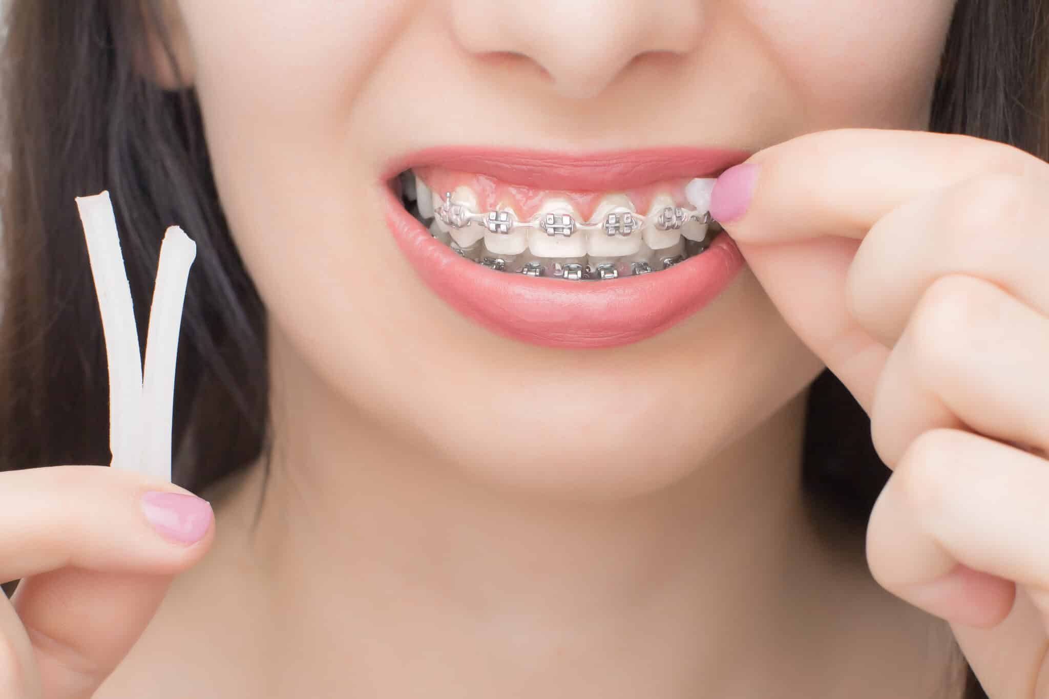 applying orthodontic wax on the dental braces. brackets on the teeth after whitening. self ligating brackets with metal ties and gray elastics or rubber bands for perfect smile.