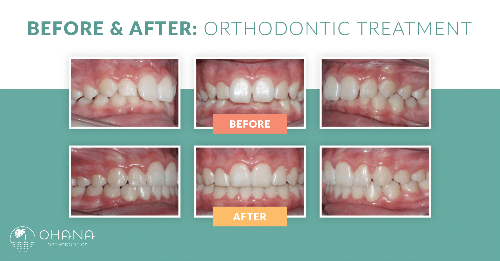 Braces Before And After How Can They Help Your Smile Ohana 