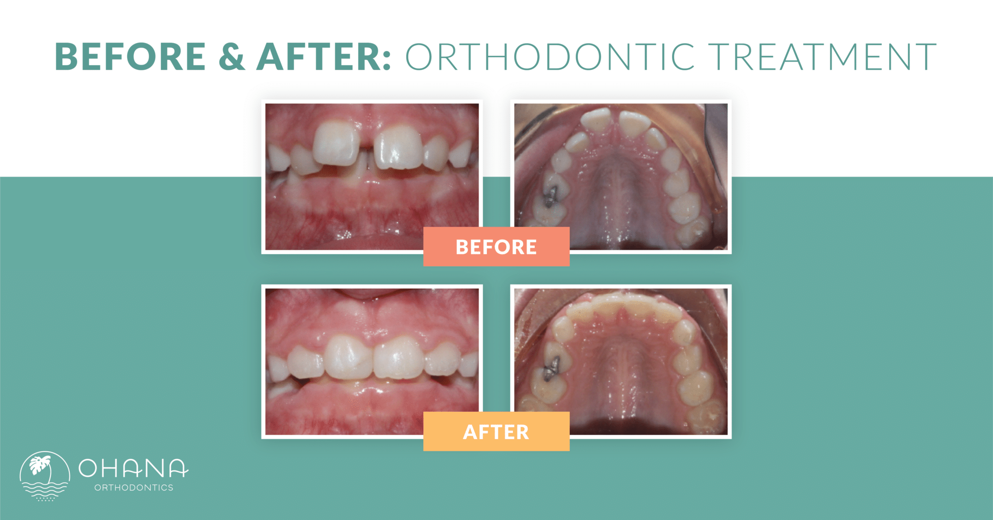 ohana beforeafter ortho patient4 1