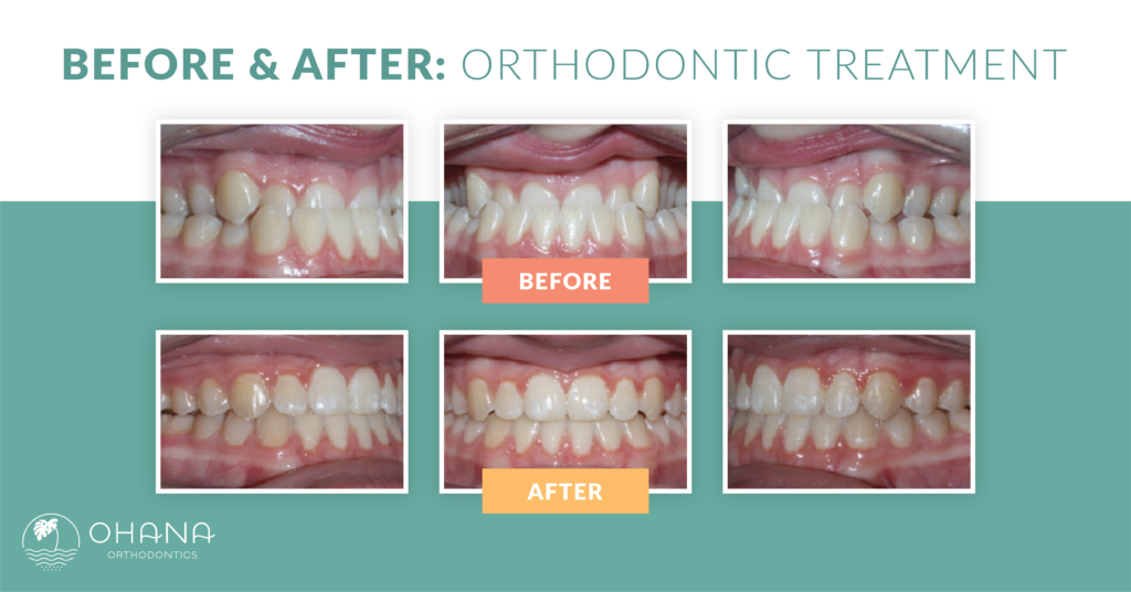 Braces Before and After How Can They Help Your Smile? Ohana