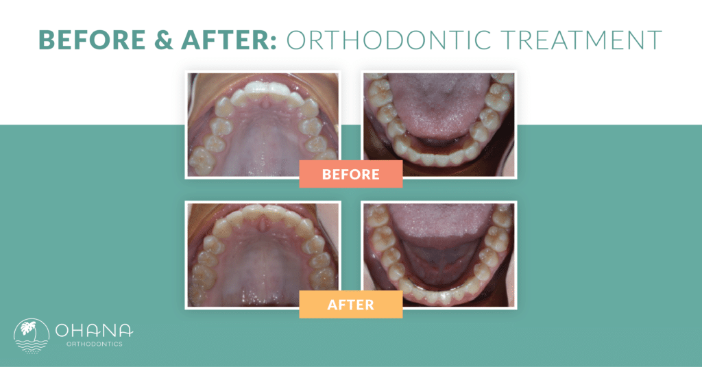 Braces Before and After How Can They Help Your Smile? Ohana