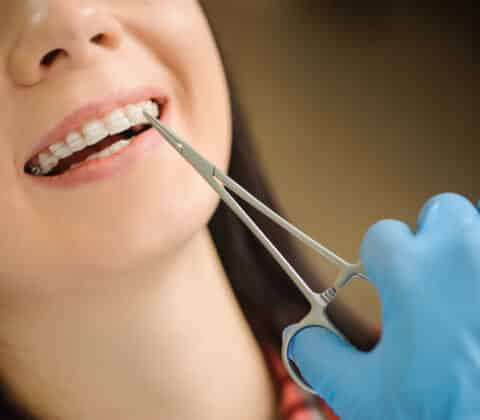 woman with ceramic braces on teeth at the dental office