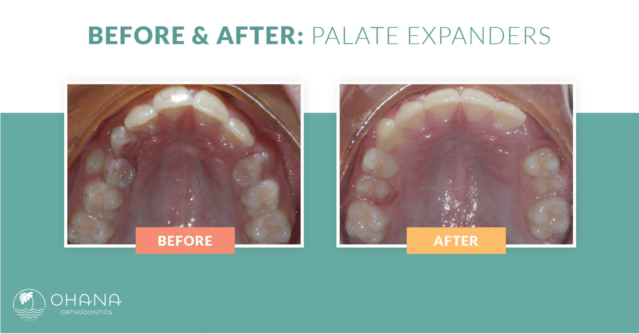 ohana beforeafter palate expander patient1 2